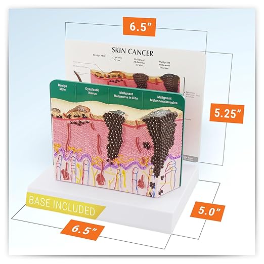 GPI Anatomicals - Skin Cancer Model, Skin Replica with Melanoma and Carcinoma for Human Anatomy and Physiology Education, Anatomy Model for Doctor's Offices and Classrooms, Medical Learning Resources
