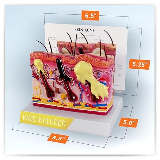 GPI Anatomicals - Skin Acne Model, Cross-Section Showing Normal and Common Acne-Riddled Skin for Human Anatomy, Physiology Education, Anatomy Model for Doctor's Office, Medical Learning Resources