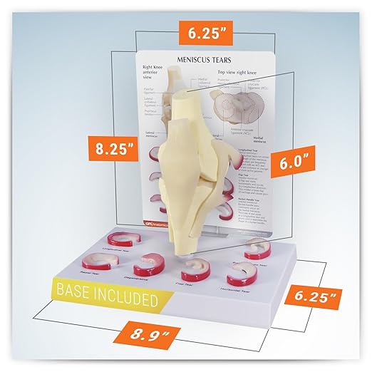 GPI Anatomicals - Human Anatomy Model of Knee Joint with Meniscus Tears, Replica for Anatomy and Physiology Education, Anatomy Model for Doctor's Office and Classrooms, Medical Learning Resources