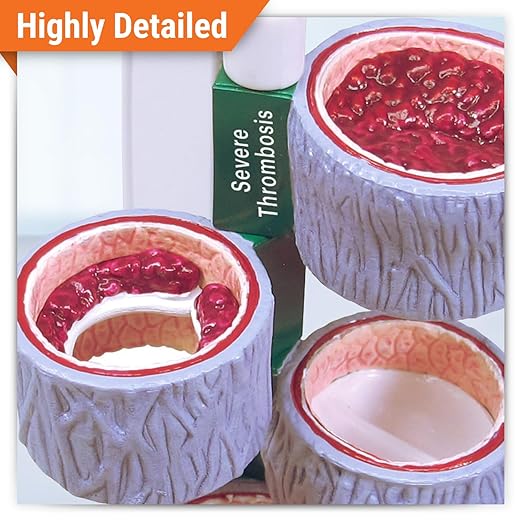 GPI Anatomicals - 4-Piece Vein Model, Replica of a Vein with Blood Clot for Human Anatomy and Physiology Education, Anatomy Model for Doctor's Offices and Classrooms, Medical Learning Resources
