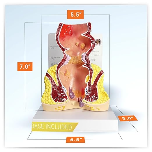 GPI Anatomicals - Human Rectum Model with Common Pathologies, Replica for Anatomy and Physiology Education, Anatomy Model for Doctor's Offices and Classrooms, Medical Learning Resources