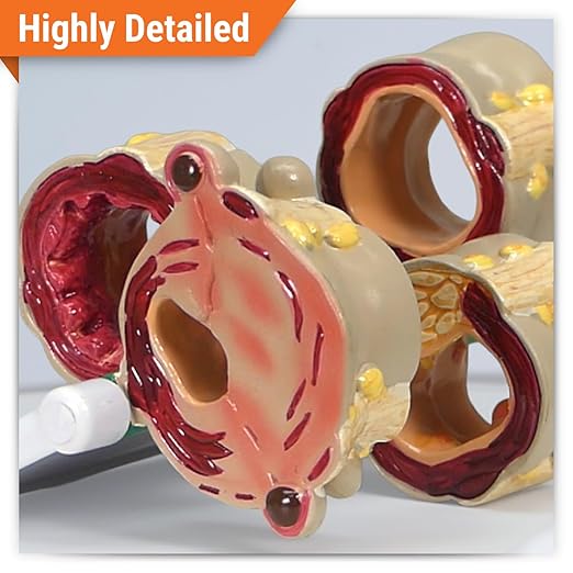 GPI Anatomicals - 4-Piece Colon Model, Replica of a Colon with Pathologies for Human Anatomy and Physiology Education, Anatomy Model for Doctor's Offices and Classrooms, Medical Learning Resources
