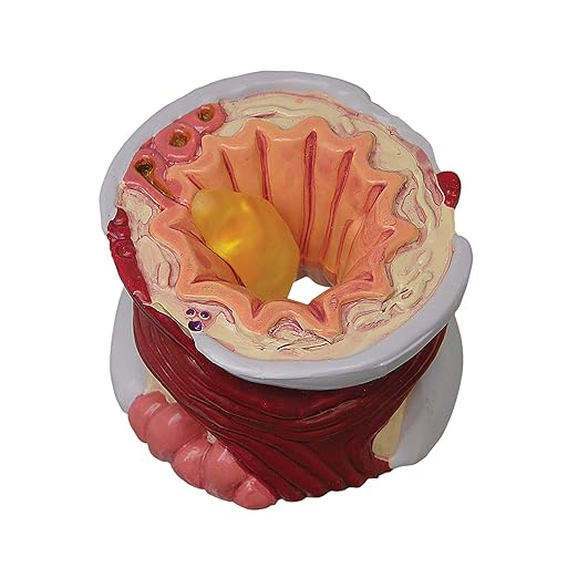 GPI Anatomicals - 4-Piece Bronchus Model, Replica of a Bronchus with Pathologies for Human Anatomy, Physiology Education, Anatomy Model for Doctor's Offices and Classrooms, Medical Learning Resources