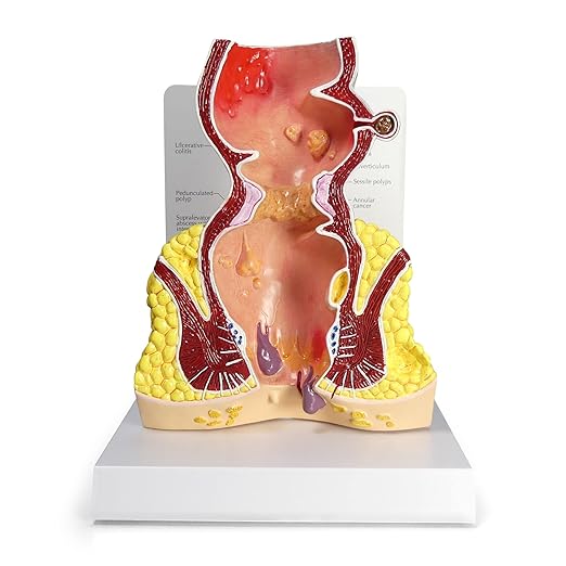 GPI Anatomicals - Human Rectum Model with Common Pathologies, Replica for Anatomy and Physiology Education, Anatomy Model for Doctor's Offices and Classrooms, Medical Learning Resources
