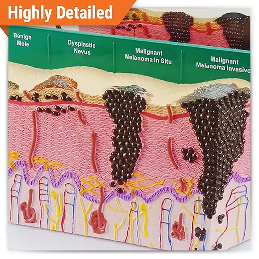 GPI Anatomicals - Skin Cancer Model, Skin Replica with Melanoma and Carcinoma for Human Anatomy and Physiology Education, Anatomy Model for Doctor's Offices and Classrooms, Medical Learning Resources