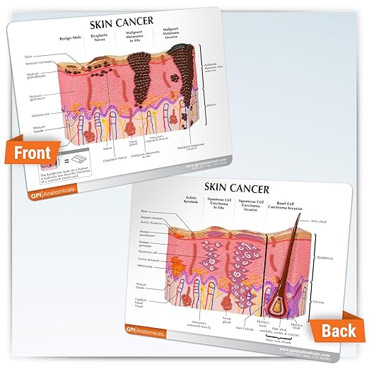 GPI Anatomicals - Skin Cancer Model, Skin Replica with Melanoma and Carcinoma for Human Anatomy and Physiology Education, Anatomy Model for Doctor's Offices and Classrooms, Medical Learning Resources