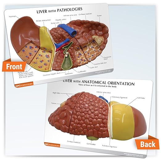 GPI Anatomicals - Liver Model with Common Pathologies, Replica for Human Anatomy and Physiology Education, Anatomy Model for Doctor's Offices and Classrooms, Medical Learning Resources