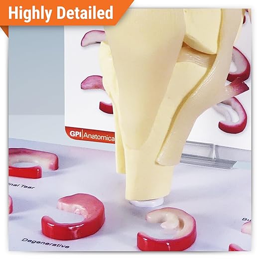 GPI Anatomicals - Human Anatomy Model of Knee Joint with Meniscus Tears, Replica for Anatomy and Physiology Education, Anatomy Model for Doctor's Office and Classrooms, Medical Learning Resources