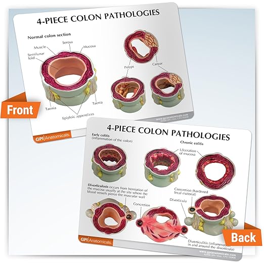 GPI Anatomicals - 4-Piece Colon Model, Replica of a Colon with Pathologies for Human Anatomy and Physiology Education, Anatomy Model for Doctor's Offices and Classrooms, Medical Learning Resources