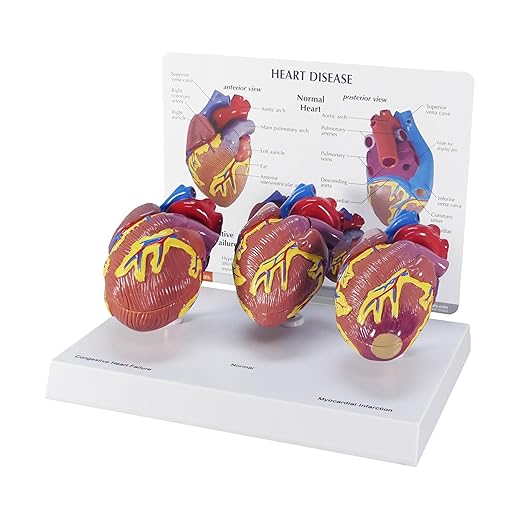 GPI Anatomicals - 3-Piece Mini Heart Model Set, Normal and Diseased Heart Models for Anatomy and Physiology Education, Anatomy Model for Doctor's Office and Classrooms, Medical Learning Resources