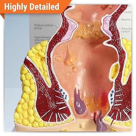 GPI Anatomicals - Human Rectum Model with Common Pathologies, Replica for Anatomy and Physiology Education, Anatomy Model for Doctor's Offices and Classrooms, Medical Learning Resources