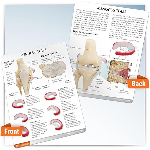 GPI Anatomicals - Human Anatomy Model of Knee Joint with Meniscus Tears, Replica for Anatomy and Physiology Education, Anatomy Model for Doctor's Office and Classrooms, Medical Learning Resources