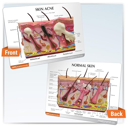GPI Anatomicals - Skin Acne Model, Cross-Section Showing Normal and Common Acne-Riddled Skin for Human Anatomy, Physiology Education, Anatomy Model for Doctor's Office, Medical Learning Resources