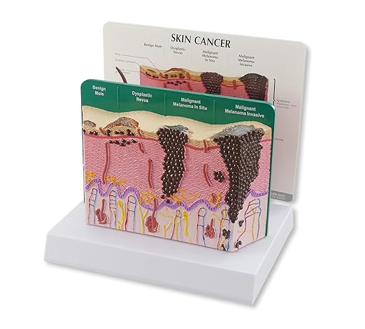GPI Anatomicals - Skin Cancer Model, Skin Replica with Melanoma and Carcinoma for Human Anatomy and Physiology Education, Anatomy Model for Doctor's Offices and Classrooms, Medical Learning Resources