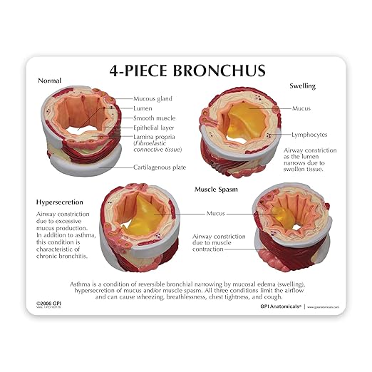 GPI Anatomicals - 4-Piece Bronchus Model, Replica of a Bronchus with Pathologies for Human Anatomy, Physiology Education, Anatomy Model for Doctor's Offices and Classrooms, Medical Learning Resources